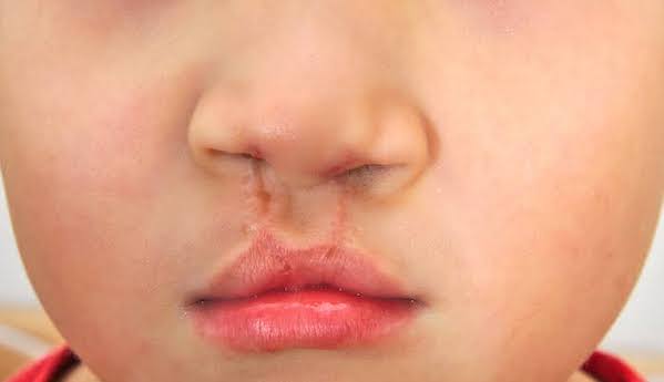 Operasi Celah Bibir dan Lelangit Gratis Untuk Bayi di Makassar, Cek Syaratnya