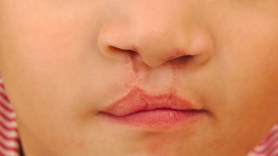 Operasi Celah Bibir Bantu Asupan Nutrisi Anak