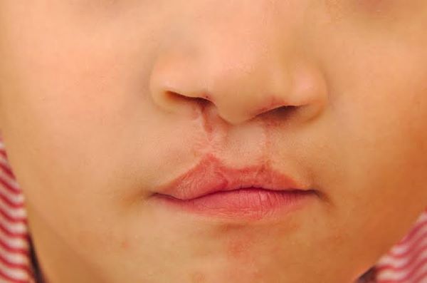 Operasi Celah Bibir Bantu Asupan Nutrisi Anak