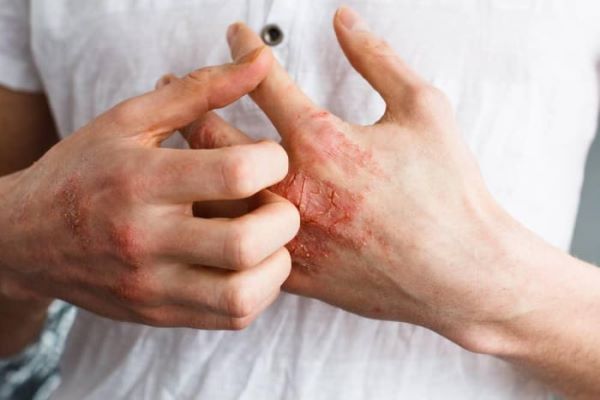 Kenali Penyakit Autoimun, Gangguan Sistem Kekebalan yang Perlu Diwaspadai