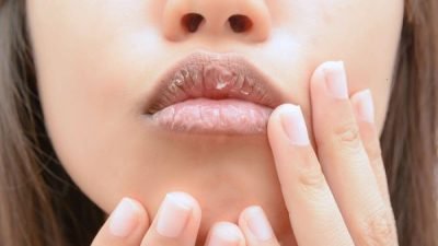 Cara Atasi Bibir Kering Saat Berpuasa
