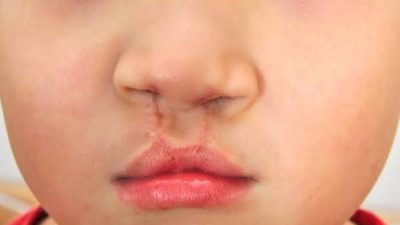 Operasi Celah Bibir dan Lelangit Gratis Untuk Bayi di Makassar, Cek Syaratnya
