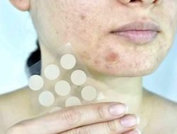 Jerawat Belum Sembuh Pakai Acne Patch? Ini Cara Menggunakannya