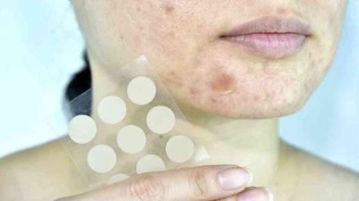 Jerawat Belum Sembuh Pakai Acne Patch? Ini Cara Menggunakannya