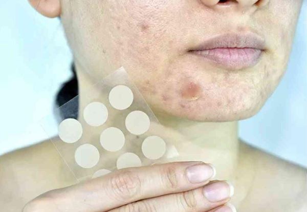 Jerawat Belum Sembuh Pakai Acne Patch? Ini Cara Menggunakannya