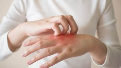 Muncul Alergi? Redakan Gejalanya Dengan Ini