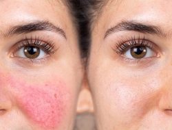 Kenali Rosacea, Penyakit Kulit Buat Wajah Jadi Memerah