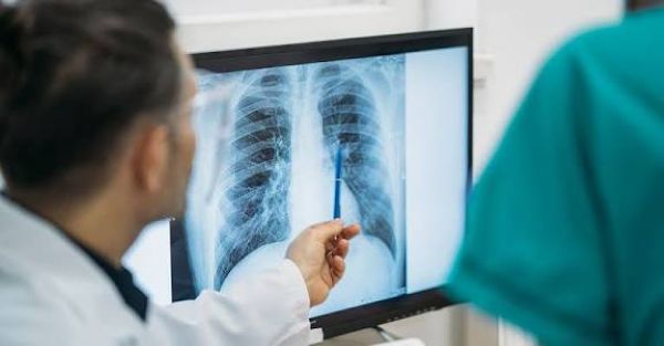 Pemerintah Siapkan Alat Rontgen TBC Gratis ke Daerah