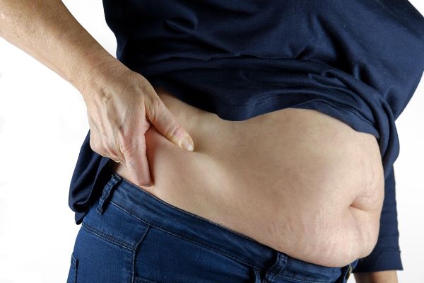 Muncul Stretch Mark? Ini Penyebab dan Cara Menguranginya Secara Alami