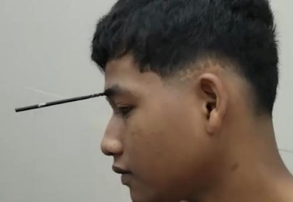 Bermain Ketapel Berujung Petaka, Remaja di Takalar Tertancap Mata Busur di Wajah