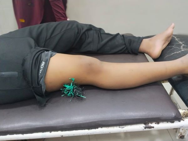 Seorang Pelajar di Takalar Jadi Korban Busur, Paha Tertancap Anak Panah