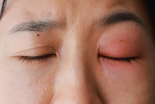 Bangun Tidur dengan Mata Bengkak? Ini 3 Penyebab Umum dan Penanganannya
